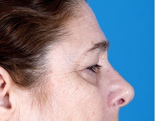 Facial Fat Grafting Before & After Patient #8748
