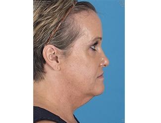 Facial Fat Grafting Before & After Patient #8741