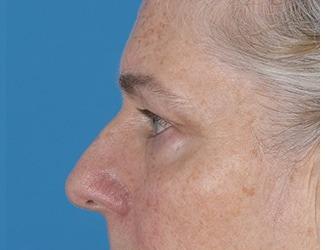 Facial Fat Grafting Before & After Patient #8744