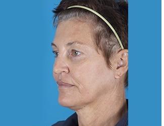 Facial Fat Grafting Before & After Patient #8742