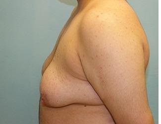 Female to Male Before & After Patient #8442