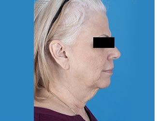 Facial Fat Grafting Before & After Patient #8740