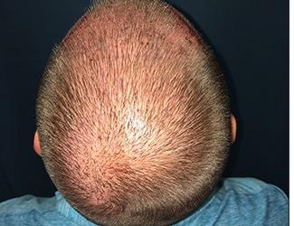NeoGraft Before & After Patient #8827