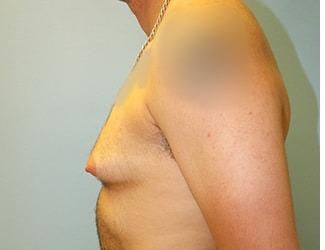 Female to Male Before & After Patient #8440