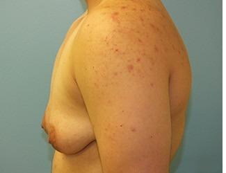 Female to Male Before & After Patient #8444