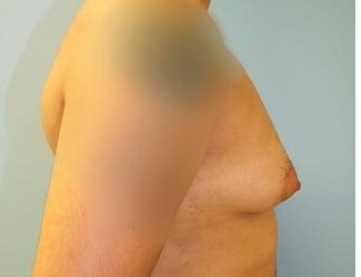 Female to Male Before & After Patient #8438