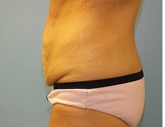 Tummy Tuck Before & After Patient #8197