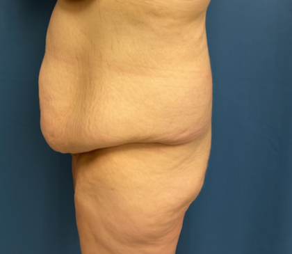 Lower Body Lift Before & After Patient #8028