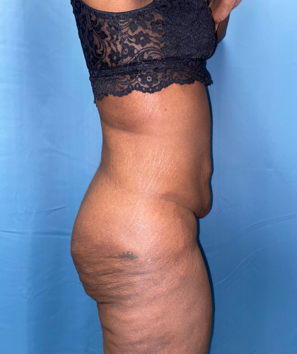 Tummy Tuck Before & After Patient #8204