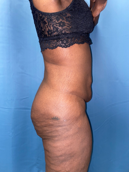 Lower Body Lift Before & After Patient #8029