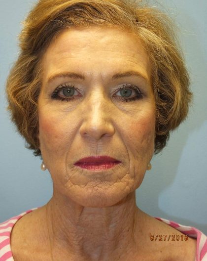 Facelift and Necklift Before & After Patient #9751