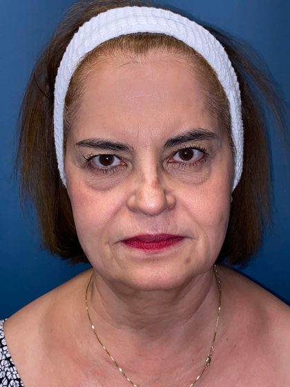 Facelift and Necklift Before & After Patient #9753