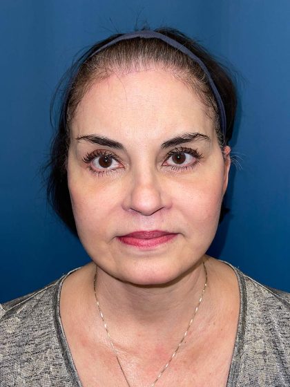 Facelift and Necklift Before & After Patient #9753