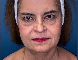 Blepharoplasty Before & After Patient #8522