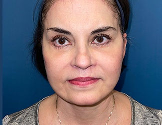 Blepharoplasty Before & After Patient #8522