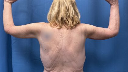 Arm Lift Before & After Patient #4899