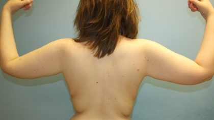 Arm Lift Before & After Patient #4755