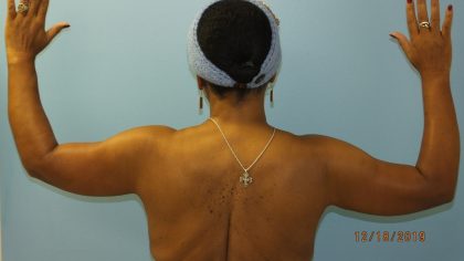 Arm Lift Before & After Patient #4805