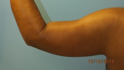 Arm Lift Before & After Patient #4805