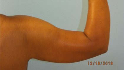 Arm Lift Before & After Patient #4805