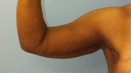 Arm Lift Before & After Patient #4805