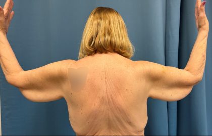 Arm Lift Before & After Patient #4899