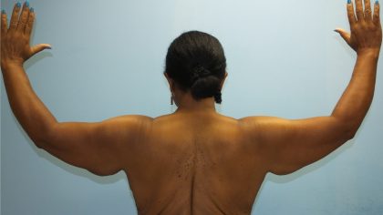 Arm Lift Before & After Patient #4805