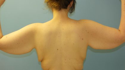 Arm Lift Before & After Patient #4755