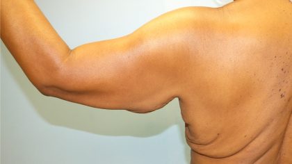 Arm Lift Before & After Patient #4805