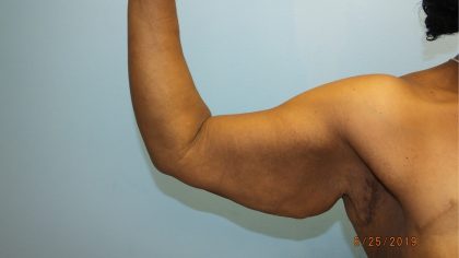 Arm Lift Before & After Patient #4805