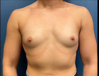 Breast Augmentation Before & After Patient #8250