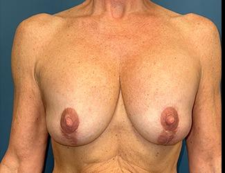 Breast Lift Before & After Patient #8374