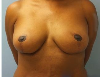 Breast Reduction Before & After Patient #8416