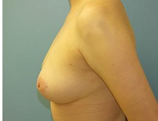 Breast Reduction Before & After Patient #8412