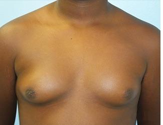 Gynecomastia Before & After Patient #8443