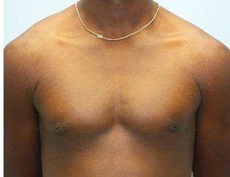 Gynecomastia Before & After Patient #8443