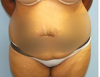 Tummy Tuck Before & After Patient #8199