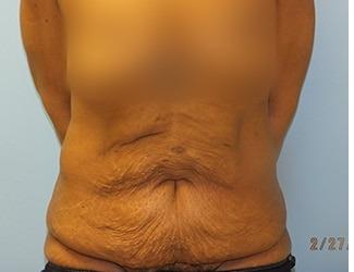 Tummy Tuck Before & After Patient #8201