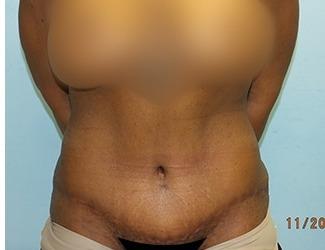 Tummy Tuck Before & After Patient #8201