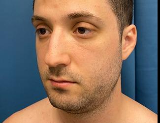 Buccal Fat Removal Before & After Patient #8470