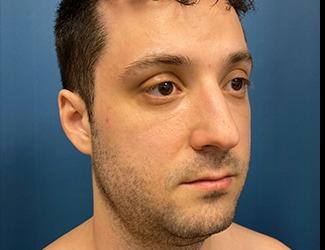 Buccal Fat Removal Before & After Patient #8470