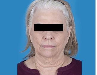 Facelift and Necklift Before & After Patient #9749