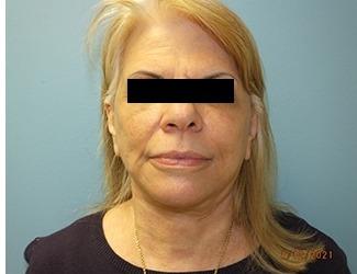 Facelift and Necklift Before & After Patient #9749