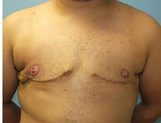 Gynecomastia Before & After Patient #8437