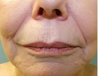 Lip Lift Before & After Patient #8800