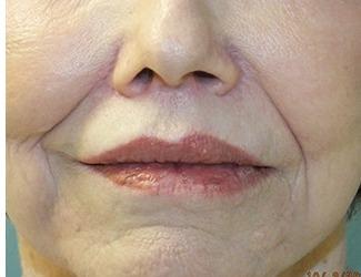 Lip Lift Before & After Patient #8800