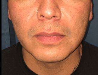 Lip Lift Before & After Patient #8806