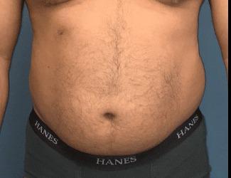 Liposuction Before & After Patient #8228