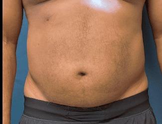 Liposuction Before & After Patient #8228