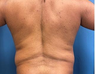 Liposuction Before & After Patient #8224